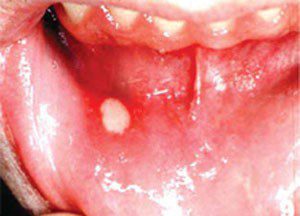 درمان آفت دهان باداروهای گیاهی