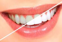 , سفیدکننده های طبیعی دندان