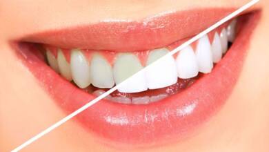 سفیدکننده های طبیعی دندان