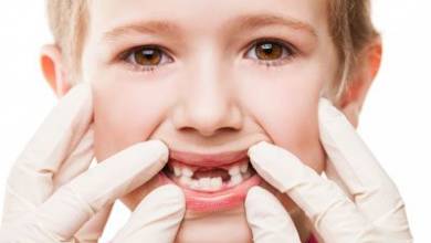 مشکل های رایج رویش دندان های دائمی در کودکان
