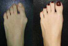 علت و درمان هالوکس یا برجسته شدن شست پا چیست؟