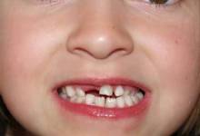 روشهای مراقبت از دندان شیری کودکان