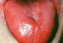 , التهاب زبان (گلوسیت)؛ علل، نشانه ها و درمان بیماری التهاب زبان