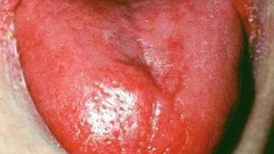 التهاب زبان (گلوسیت)؛ علل، نشانه ها و درمان بیماری التهاب زبان
