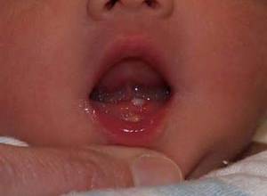 نوزادانی که موقع تولد دندان دارند !