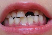 علت بی نظم درآمدن دندان دائمی