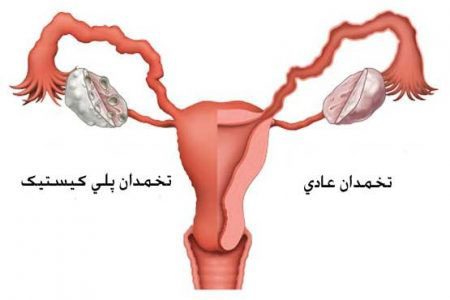 تشخیص تخمدان پلی کیستیک در دختران