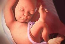 بند ناف تک شریانی چیست و آیا باعث سقط جنین می شود؟