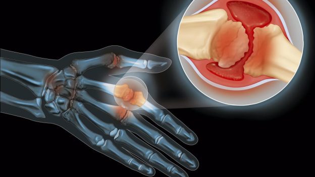 آرتروز دست چیست و چگونه درمان می‌شود؟